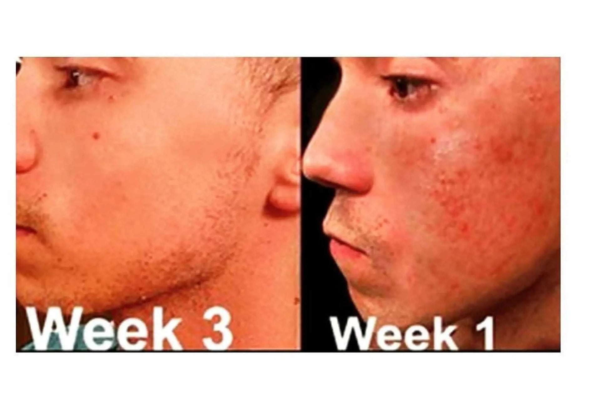 Before and after comparison of acne treatment results in weeks 1 and 3 using Complete Acne System.